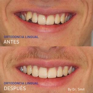 ES - Fotos de antes y después de la ortodoncia lingual del Dr. Smit