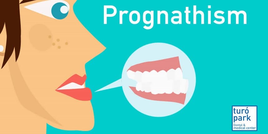 Mandibular Prognathism- The Royal Jaw