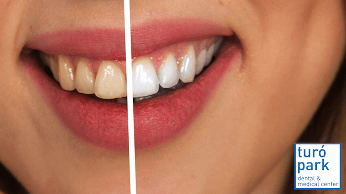 teeth whitening - english speaking dentis barcelona - turo park dental and medical clinic center