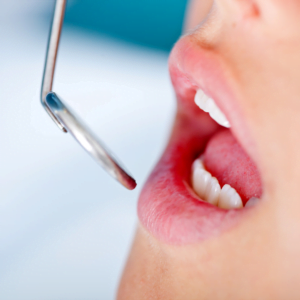 Deep cavity treatment with a qualified dentist