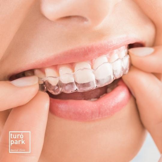 Everything you need to know about Invisalign: the invisible orthodontics  you just notice. - Puy - Dental Clinic (Barcelona)