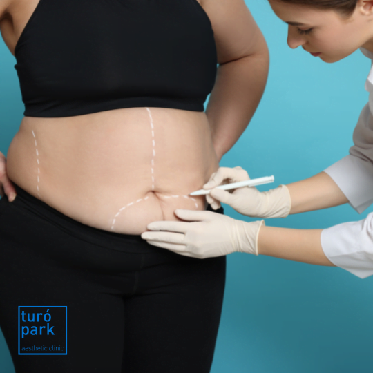 Abdominoplastia y cirugía plástica