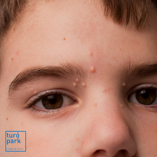 Treatment of molluscum contagiosum - Turó Park Clinics