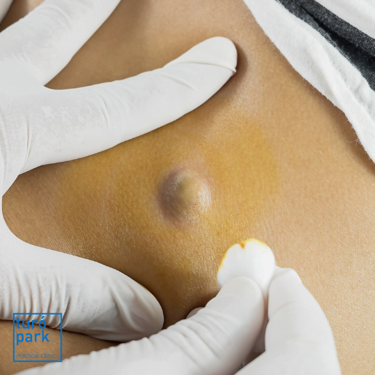 When Are Sebaceous Cysts Cause for Concern?: Lakeland Surgical