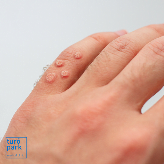 treatment of warts