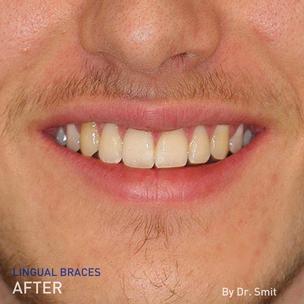 EN - after picture of Dr. Smit's lingual braces