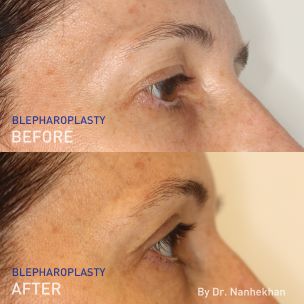 EN - before and after pictures from a side angle of Dr. Lloyd Nanhekhan's blepharoplasty