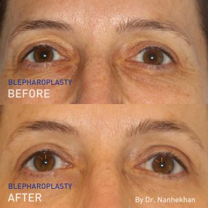 before and after pictures from straight on of Dr. Lloyd Nanhekhan's blepharoplasty
