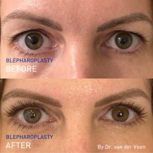 EN - before and after pictures of Dr. Rob van der Veen's blepharoplasty