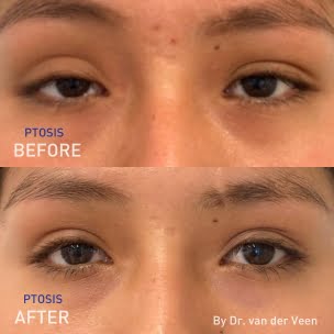 EN - before and after pictures of Dr. Rob van der Veen's ptosis surgery
