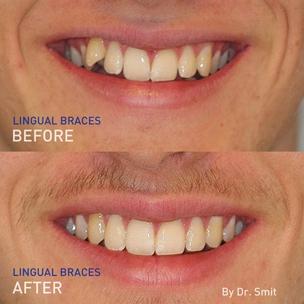 EN - before and after pictures of Dr. Smit's lingual braces