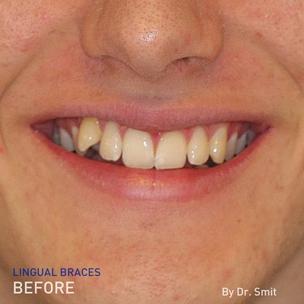 EN - before picture of Dr. Smit's lingual braces