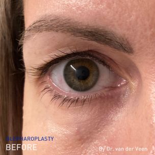 EN - before picture of the right eye of Dr. Rob van der Veen's blepharoplasty