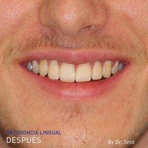 ES - foto de después de la ortodoncia lingual del Dr. Smit