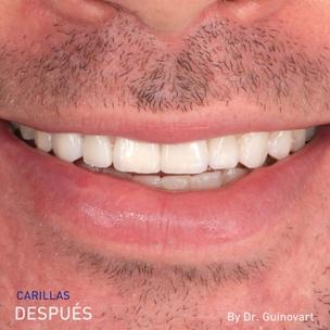 Las carillas dentales ¡el secreto de los famosos! - Clinica Dental Centro  de Barcelona - The Practice