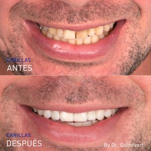 ES - fotos de antes y después de las carillas dentales del Dr. Guinovart