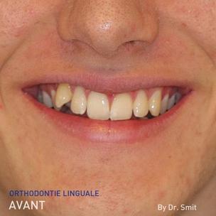 FR - Photo avant de l'orthodontie linguale du Dr Smit