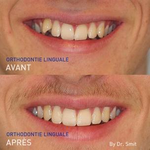 FR - Photos avant et après l'orthodontie linguale du Dr Smit