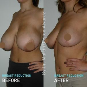Breast reduction side view by Dr. Martin Gaston Alvarez