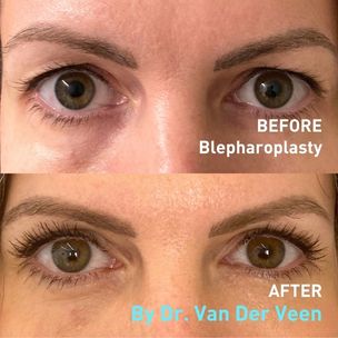 Before and After Blepharoplasty