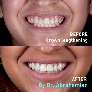 Before and After Crown Lenthening
