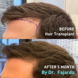 Before and After Hair transplant