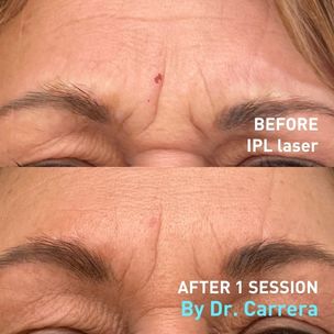 Before and After IPL laser