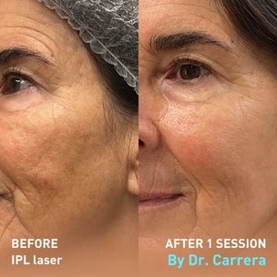 Before and After Laser IPL Manchas