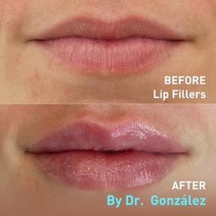 Before and After Lip fillers
