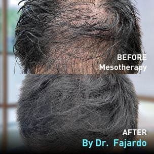 Before and After Mesotherapy