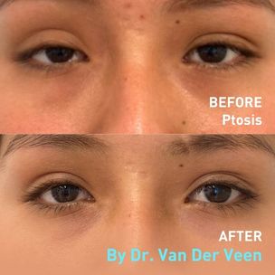 Before and After Ptosis
