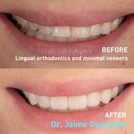 before and after veneers 