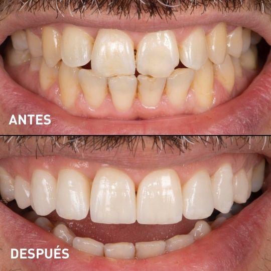 Antes y Después Carillas