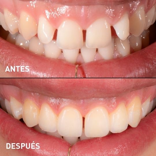 Antes y Después Carillas
