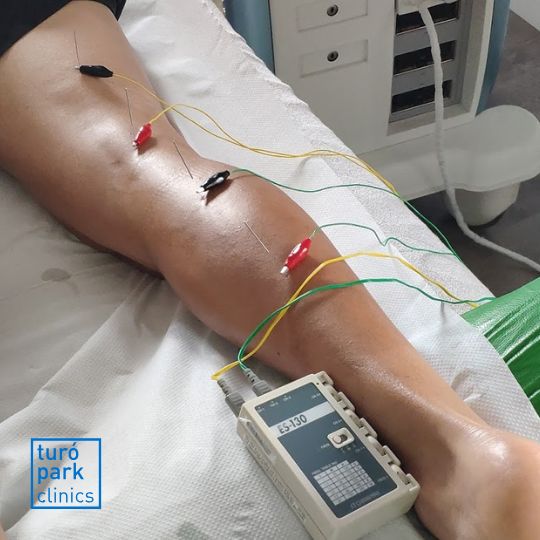 Kinésithérapeute pratiquant la neuromodulation percutanée pour traiter la douleur chronique à Barcelone