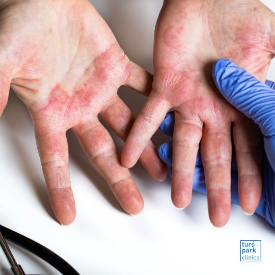 Un dermatologue examine une poussée de dermatite atopique chez un patient à la clinique Turó Park.
