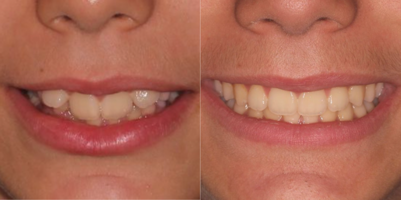 Invisalign
