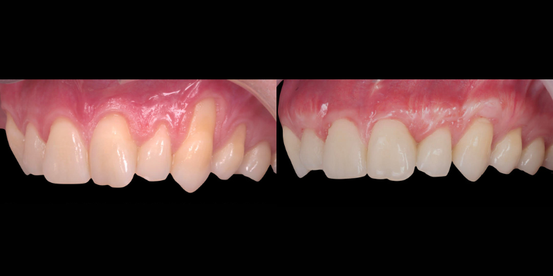 Gingivectomía