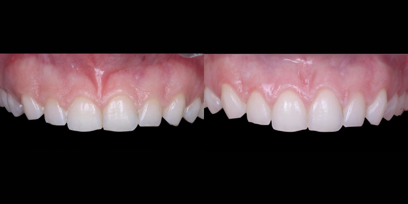 Gingivectomía