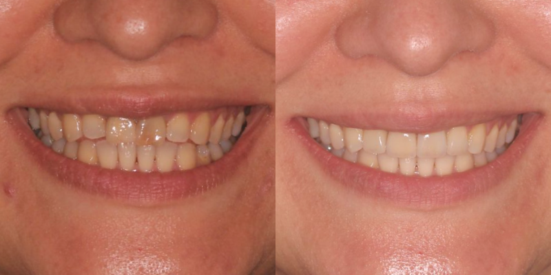 Invisalign + Carillas