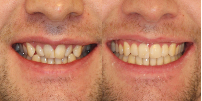 Invisalign