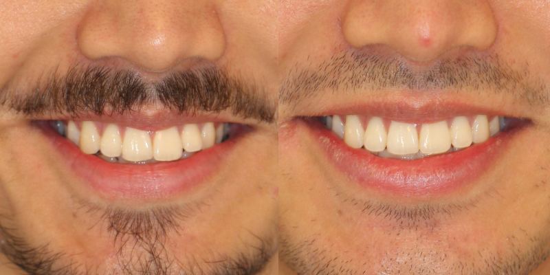 Invisalign