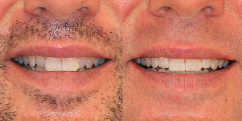 Invisalign
