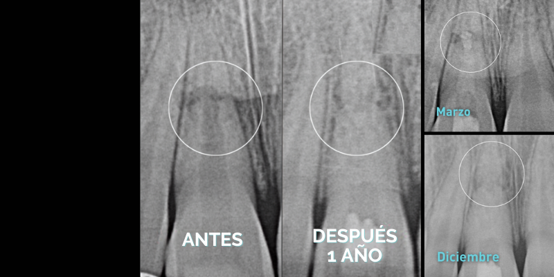 Endodoncia