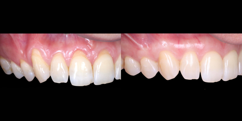 Gingivectomía