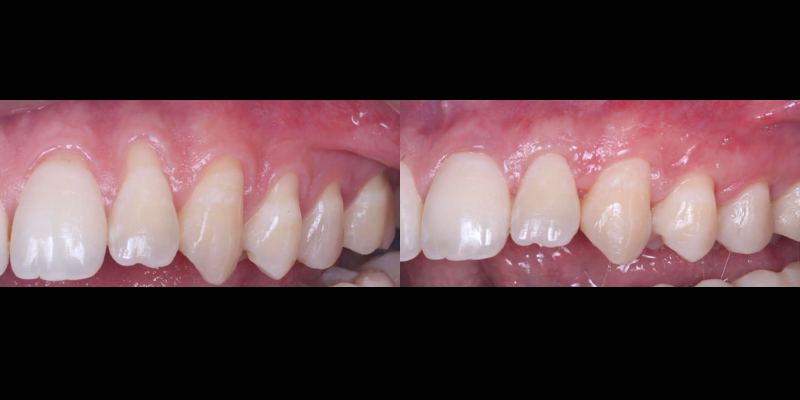 Gingivectomía