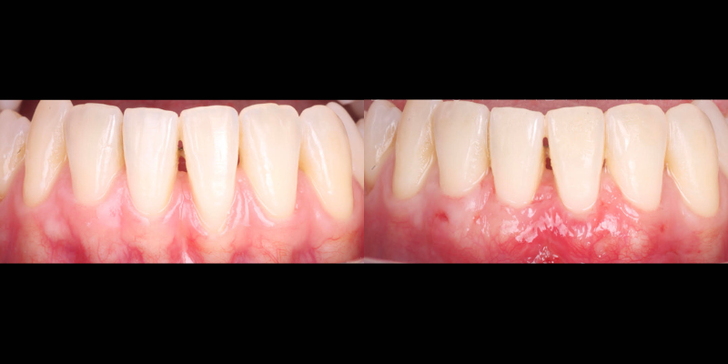 Gingivectomía