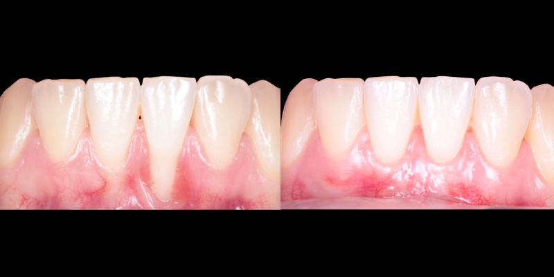 Gingivectomía