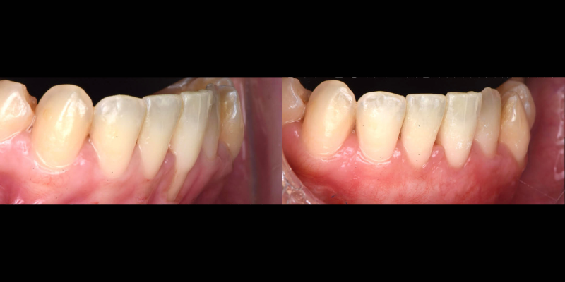 Gingivectomía