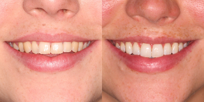 Invisalign